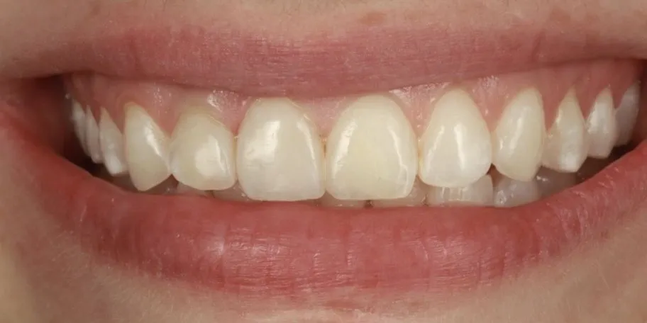 After: Dark teeth camouflaged