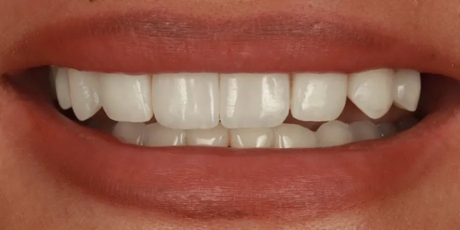 After: Failing composite veneers that looked unnatural, taken off and remade
