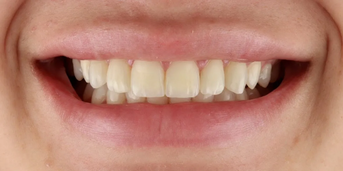 After: Front-teeth proportions evened out with bonding, spaces closed and white and dark spots hidden