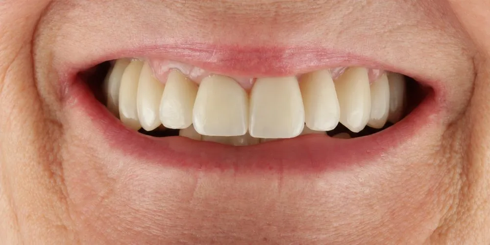 After: Old restorations that were failing, remade as veneers, crowns and bridges