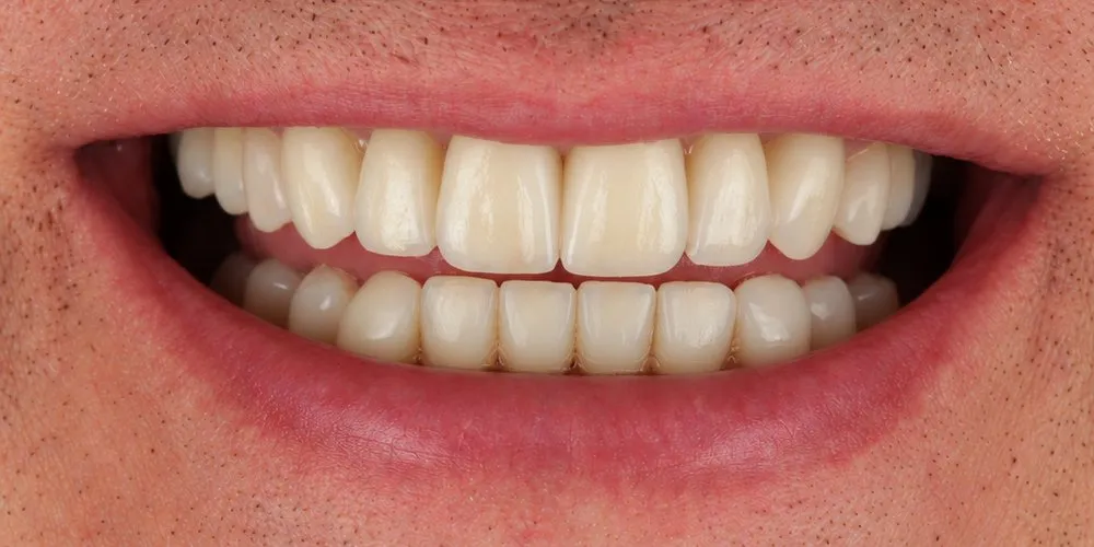 After: Veneers to refresh the whole smile
